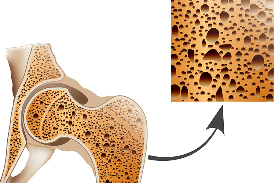 Día Mundial de la Osteoporosis