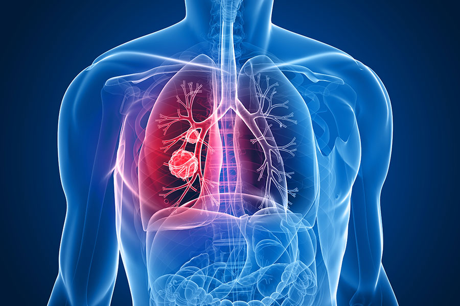 Cáncer de pulmón: el cáncer más común a nivel global