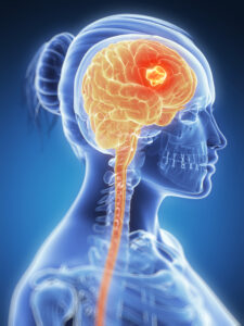 El glioblastoma (GB) es el tumor cerebral primario mas comun, agresivo y letal del grupo de tumores del Sistema Nervioso Central (SNC).