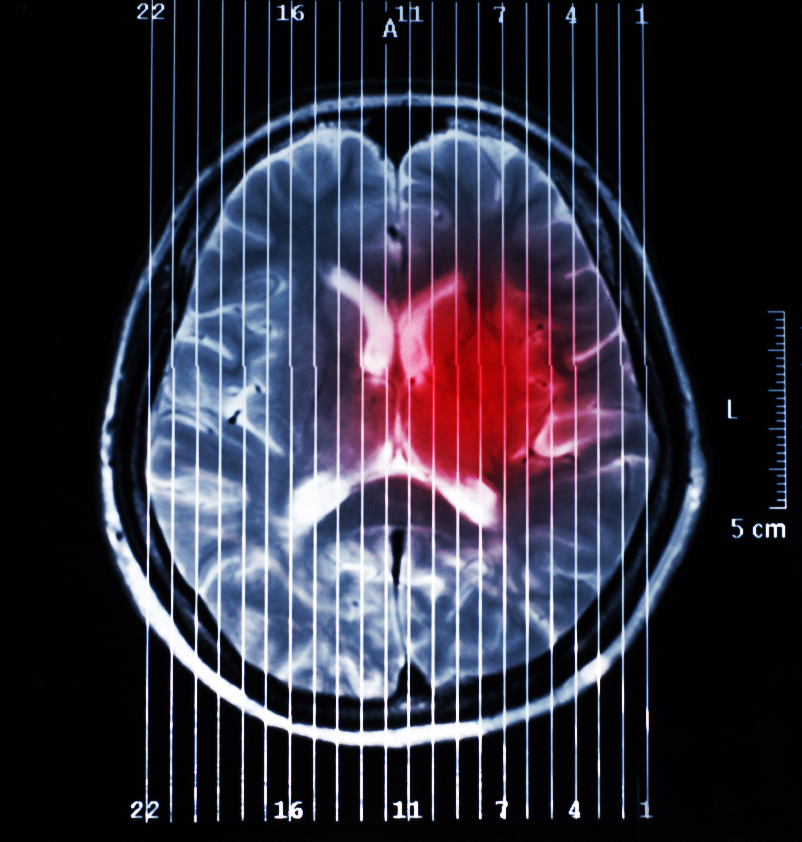 Glioblastoma: el tumor cerebral primario más común, agresivo y letal