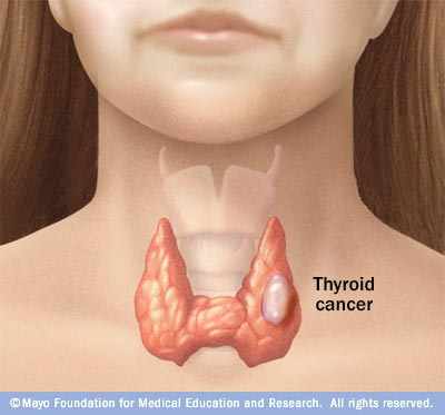 Mayor detección de tumores de bajo riesgo aumenta tasas de cáncer de tiroides