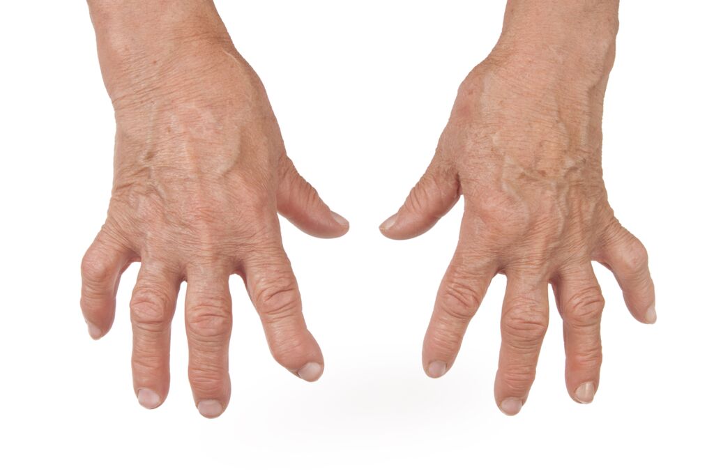 80% de los pacientes con Artritis Reumatoide tardan más de 5 años en ser diagnosticados