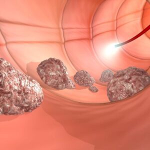 Cáncer colorrectal visto por colonoscopía.