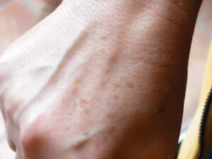 Muchos factores influyene en la aparición de manchas en las manos.