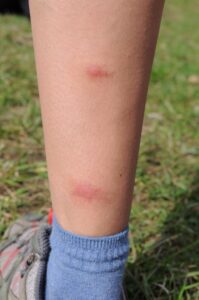 Las picaduras de mosquitos (zancudos) y purrujas son las más frecuentes en Costa Rica.