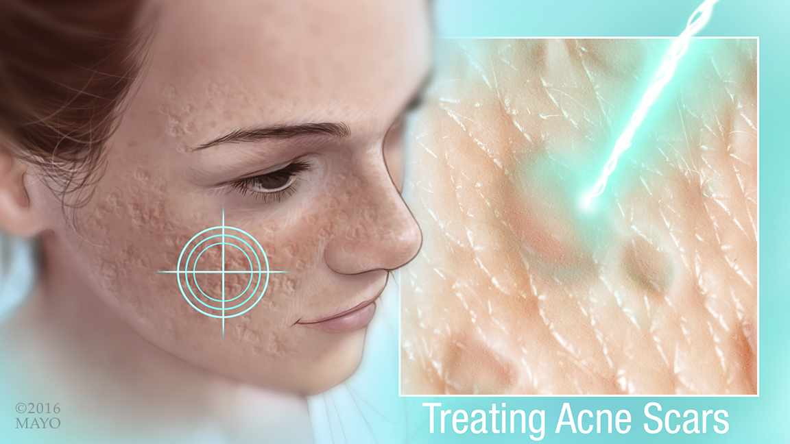 ¿Cómo tratar las cicatrices del acné?