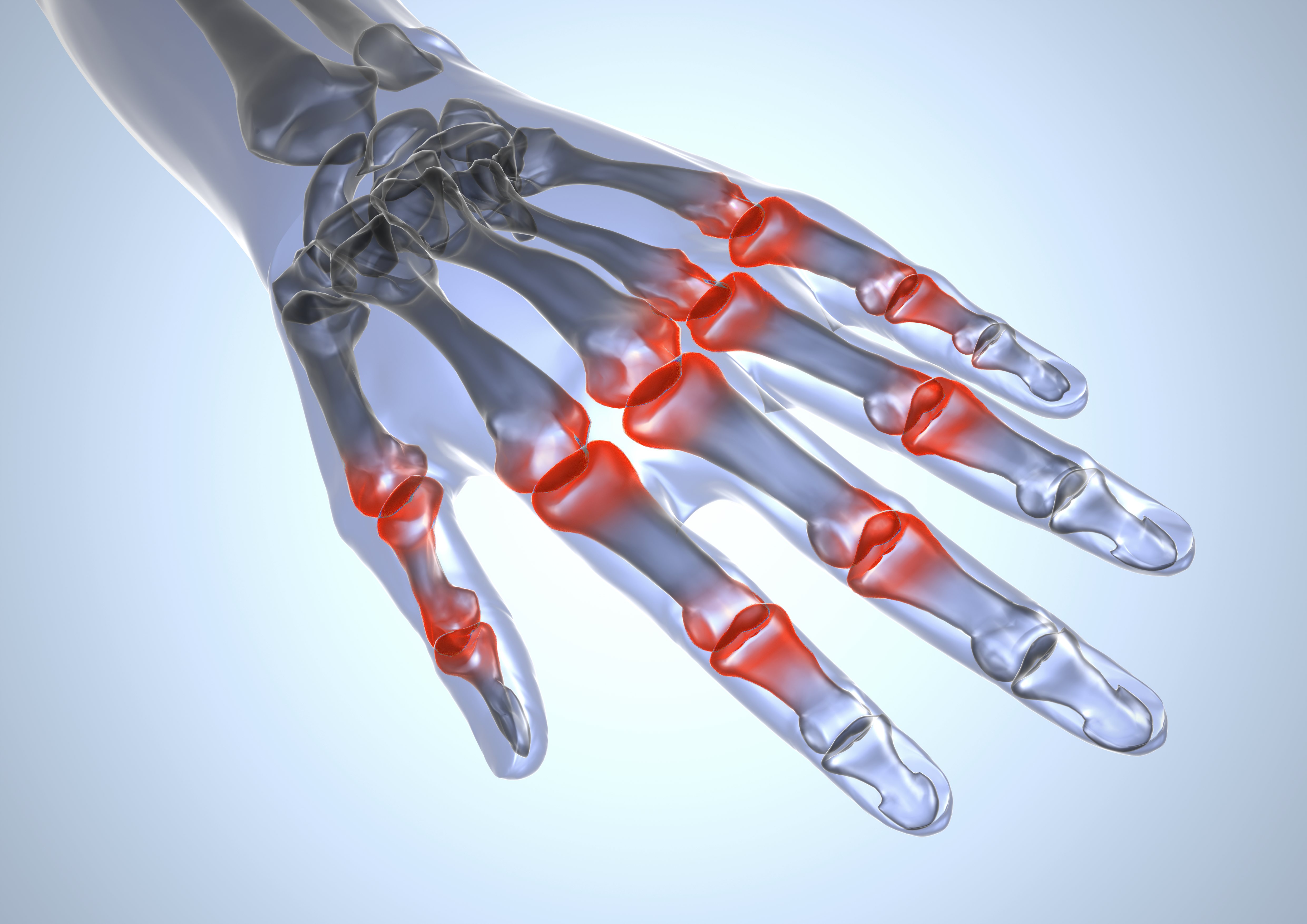 ¿Cuáles cuidados debe tener un paciente con artritis reumatoide?