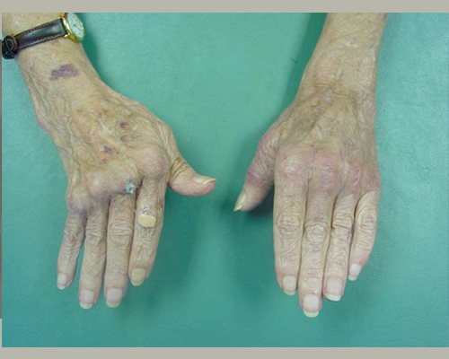 ¿Sufre de Artritis Reumatoide?