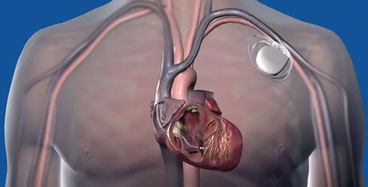 Investigadores imprimen en 3D un corazón hecho de células de pacientes humanos