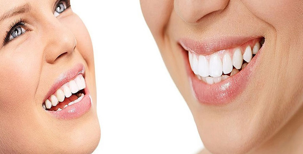 Conozca los 5 principios básicos antes de realizarse un blanqueamiento dental