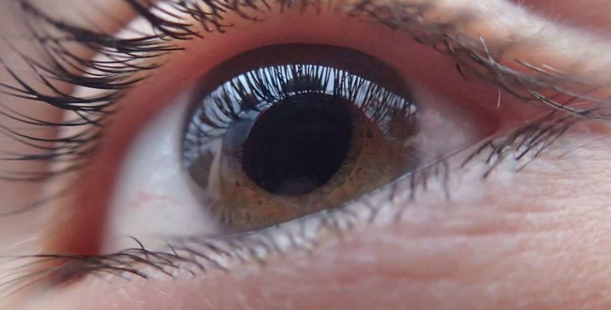 Glaucoma es la segunda causa irreversible de ceguera