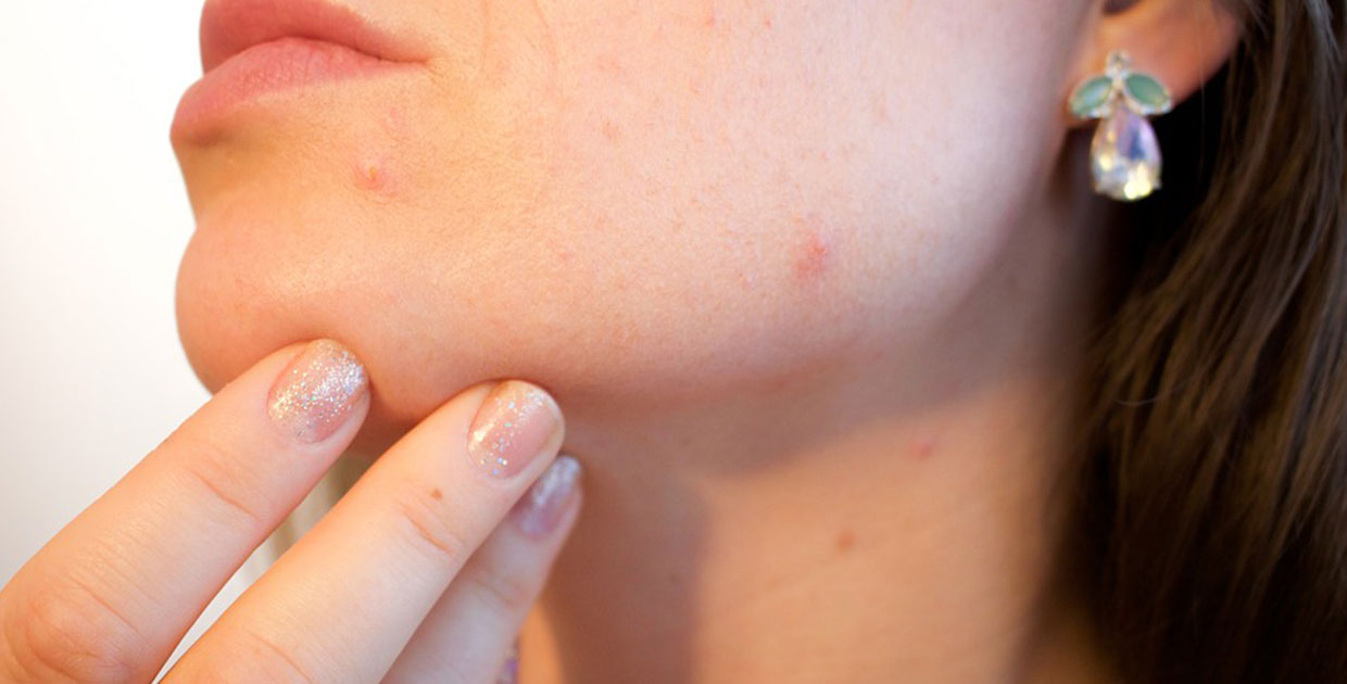 Cambios hormonales durante la mediana edad en las mujeres, pueden derivar en acné