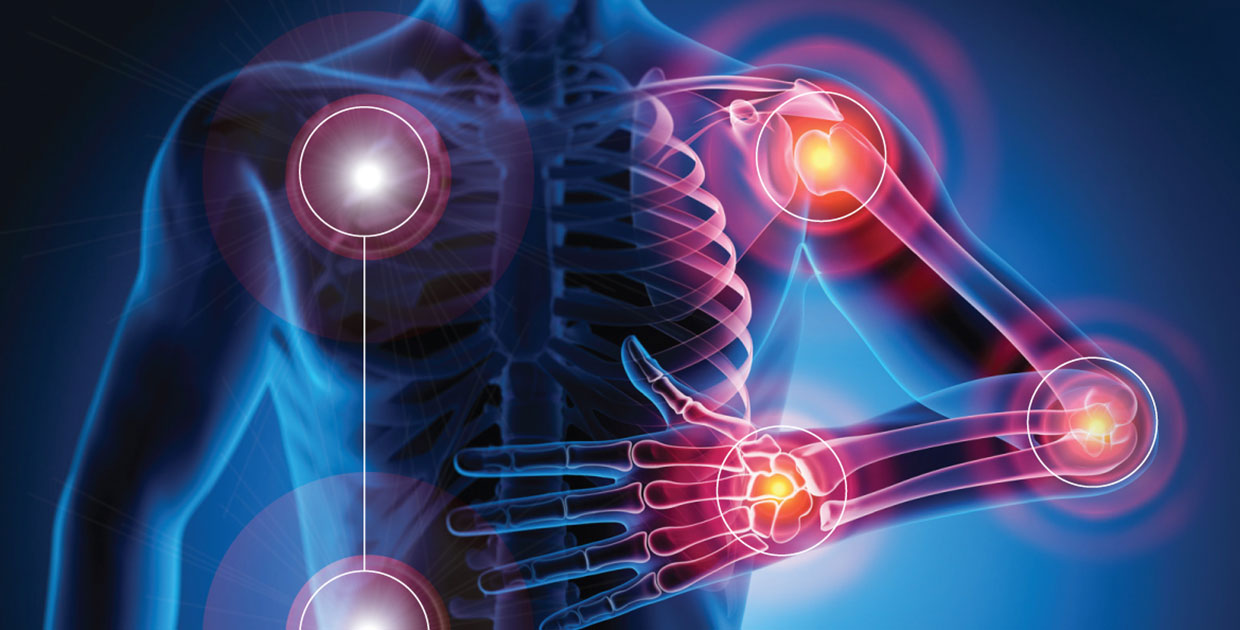 Artritis Reumatoide, enfermedad que afecta las articulaciones de manera irreversible