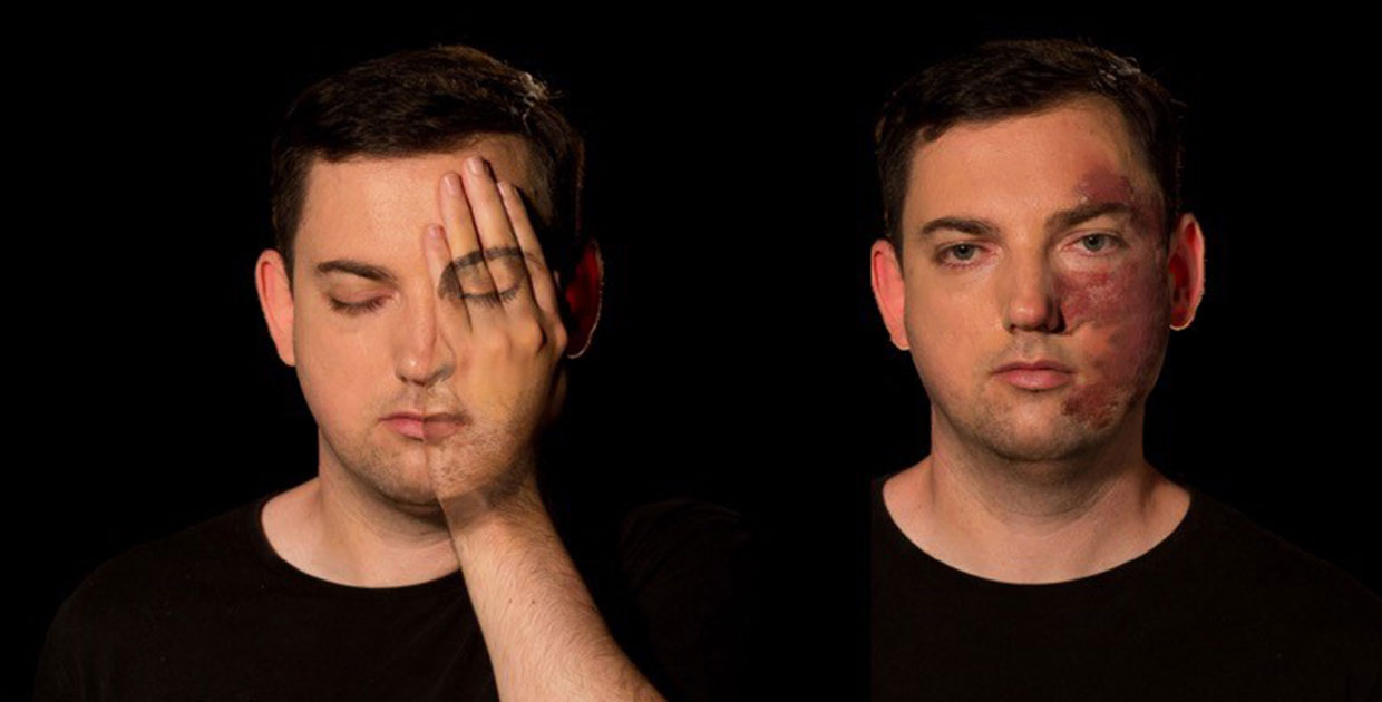 La psoriasis afecta la calidad de vida de  quienes la padecen