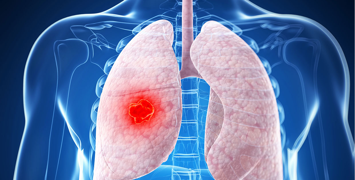 Cáncer de pulmón es altamente letal y difícil de diagnosticar