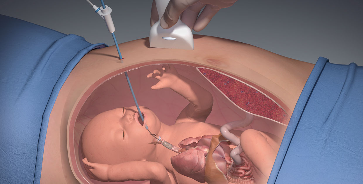 Mayo Clinic: Innovación en cirugía fetal