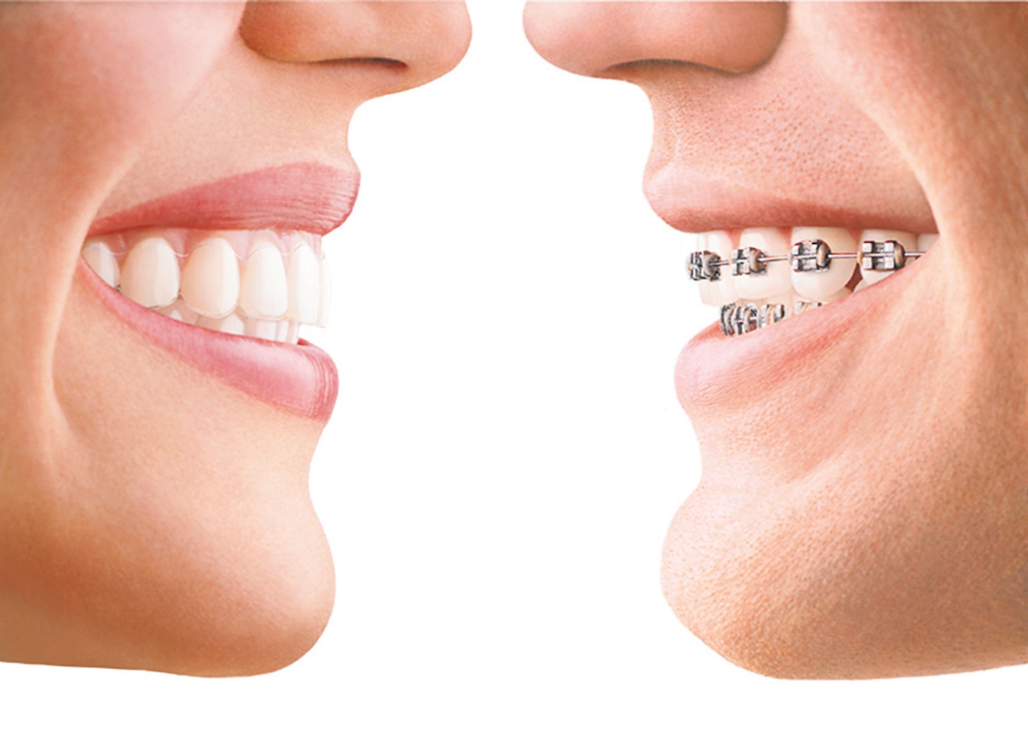 Cuáles son los beneficios de la ortodoncia invisible