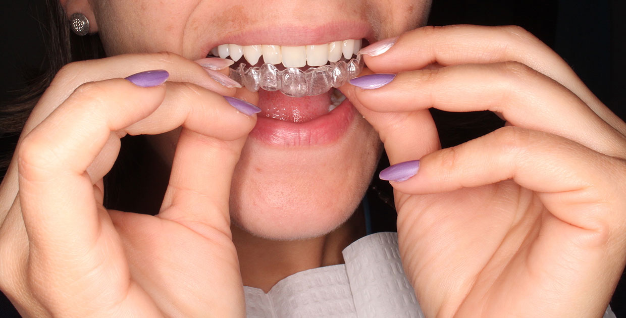 Ortodoncia invisible permite tener resultados en menos tiempo