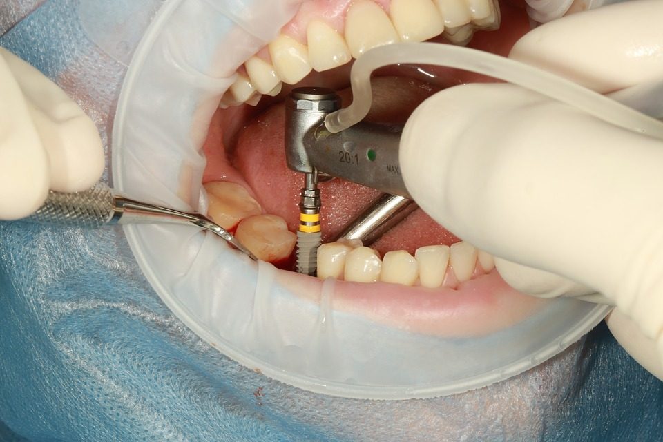 Conozca las diferencias entre una prótesis y un implante dental