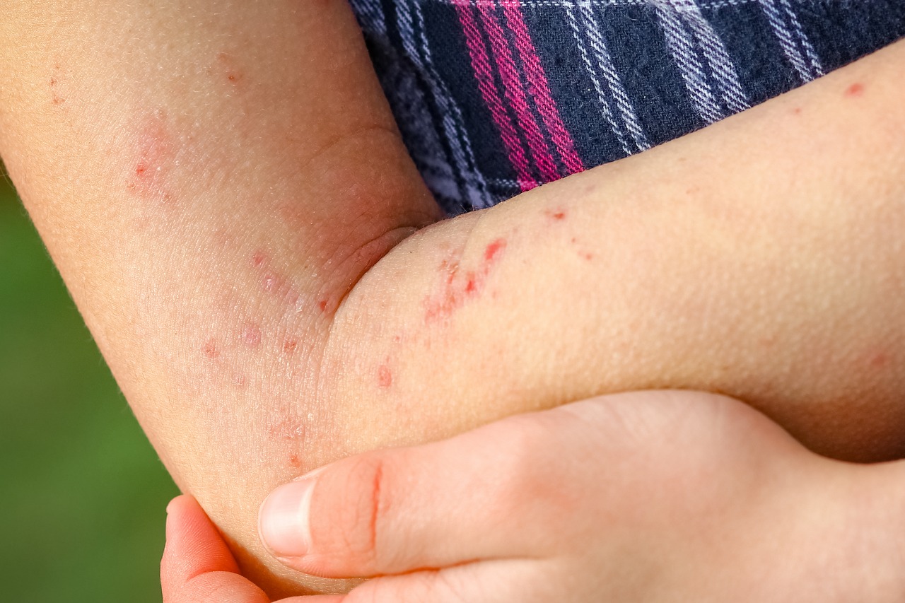 Dermatitis Atópica desafía a pacientes