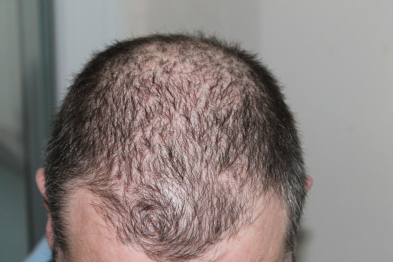 Mitos sobre la pérdida de cabello masculina