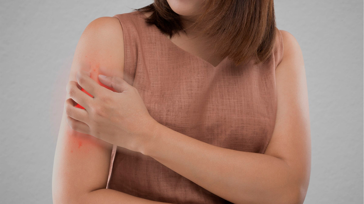 Pacientes con Dermatitis Atópica pueden tener comprometida su salud con brotes intensos hasta 6 meses en el año