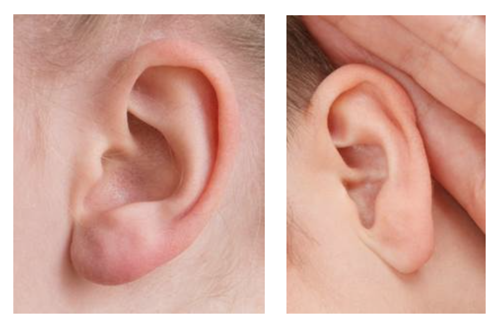 El tapón de cerumen es una de las causas más comunes de pérdida de la audición
