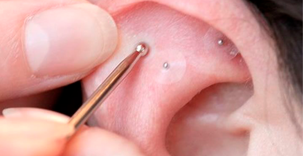 Auriculoterapia, la técnica terapéutica ayuda con la gastritis, colitis, ansiedad y otras enfermedades