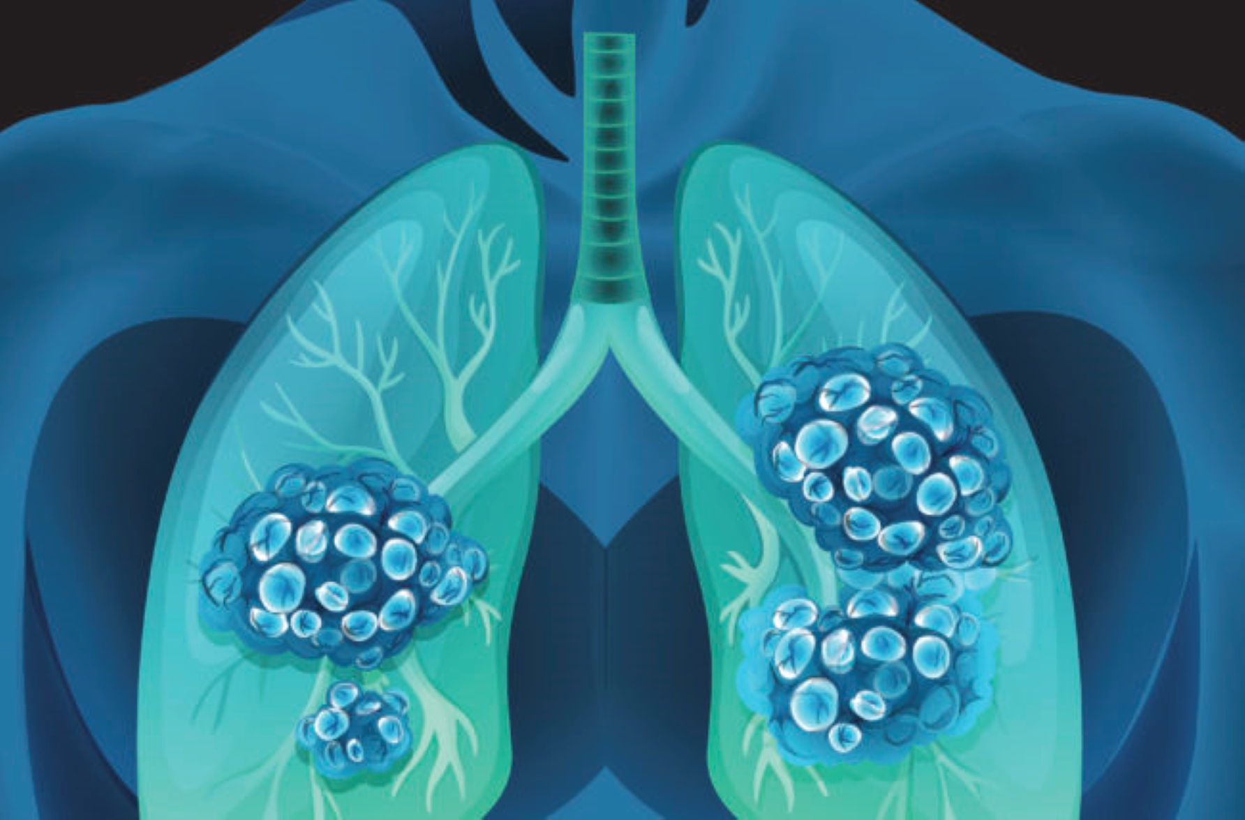 La broncoscopia, el aliado más grande para prevenir decesos a causa de cáncer de pulmón en Guatemala