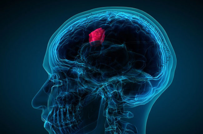 ¿Cuáles son las señales de advertencia reales de un tumor cerebral?