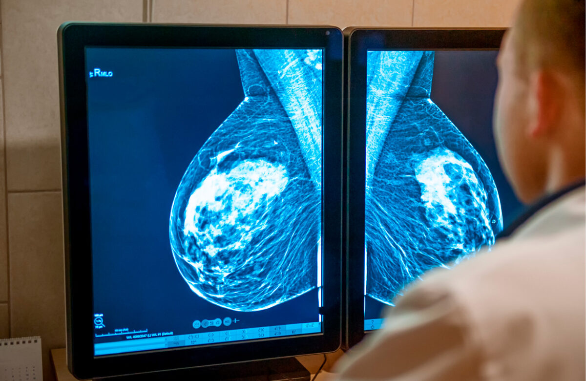 Entendiendo el cáncer de mama triple negativo: detección temprana y tratamiento