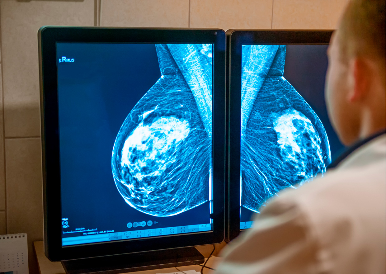 Entendiendo el cáncer de mama triple negativo: detección temprana y tratamiento