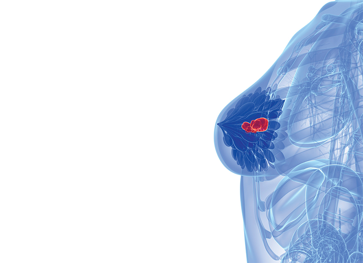 Cáncer de mama metastásico