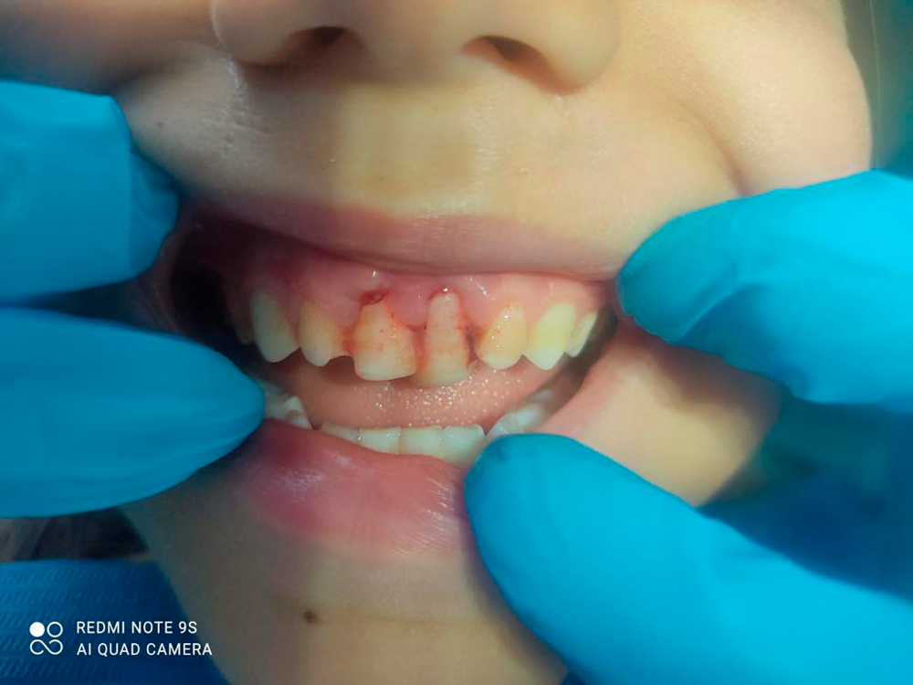 Entre el 15% y 40% de los niños sufren  de un trauma dental en la infancia