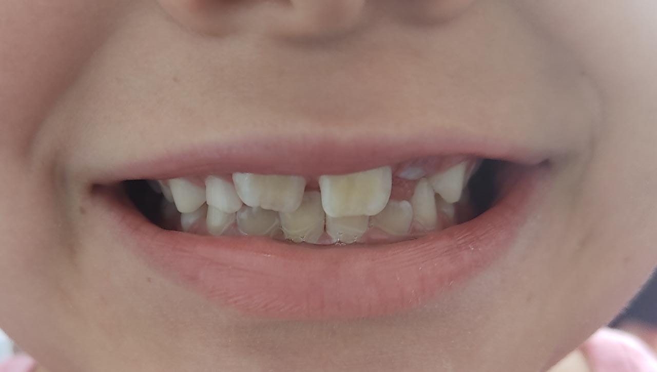 Durante los 3 primeros años de vida, es probable la aparición de anomalías en el esmalte dental