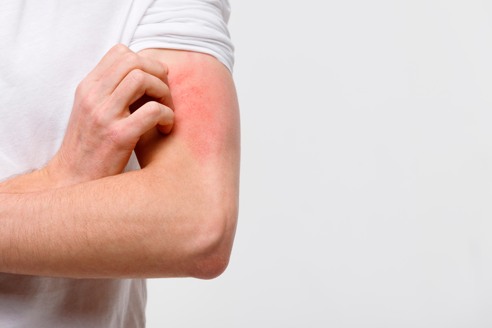 El estrés desencadena y perpetúa la dermatitis atópica  hasta en un 50% de los pacientes