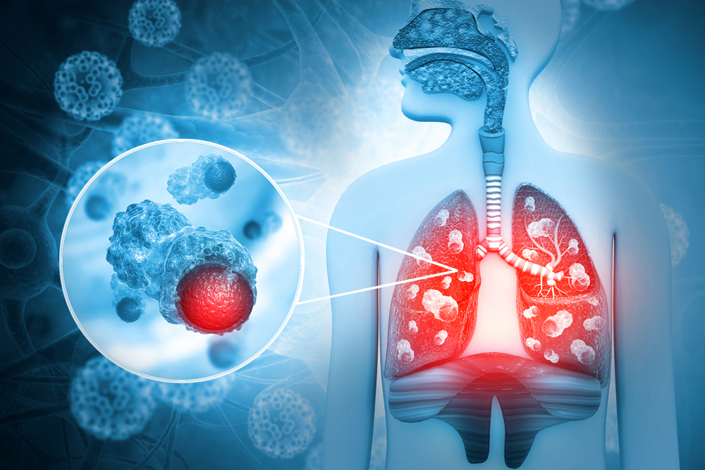 La medicina de precisión revoluciona el abordaje  del cáncer de pulmón