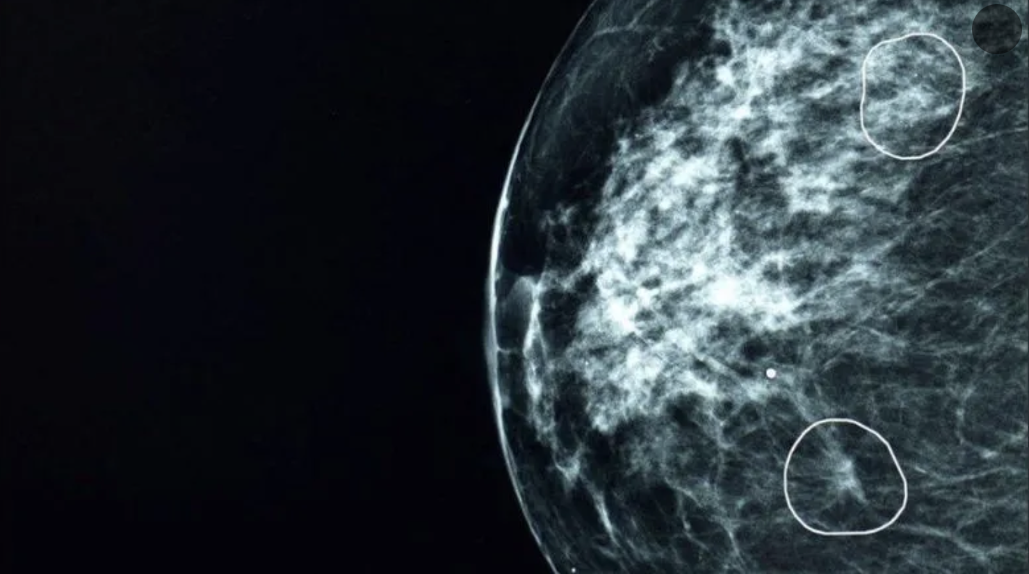 Conozca cómo funciona la herramienta de IA que detecta tumores de cáncer