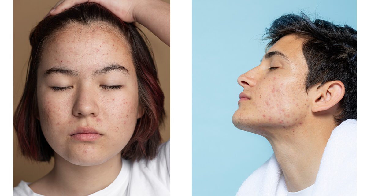 Investigación revela la importancia del equilibrio bacteriano en la piel para combatir el acné y otras afecciones