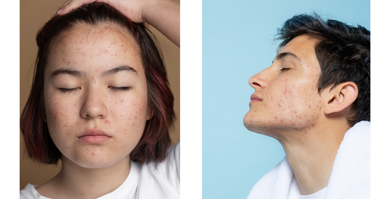 Investigación revela la importancia del equilibrio bacteriano en la piel para combatir el acné y otras afecciones