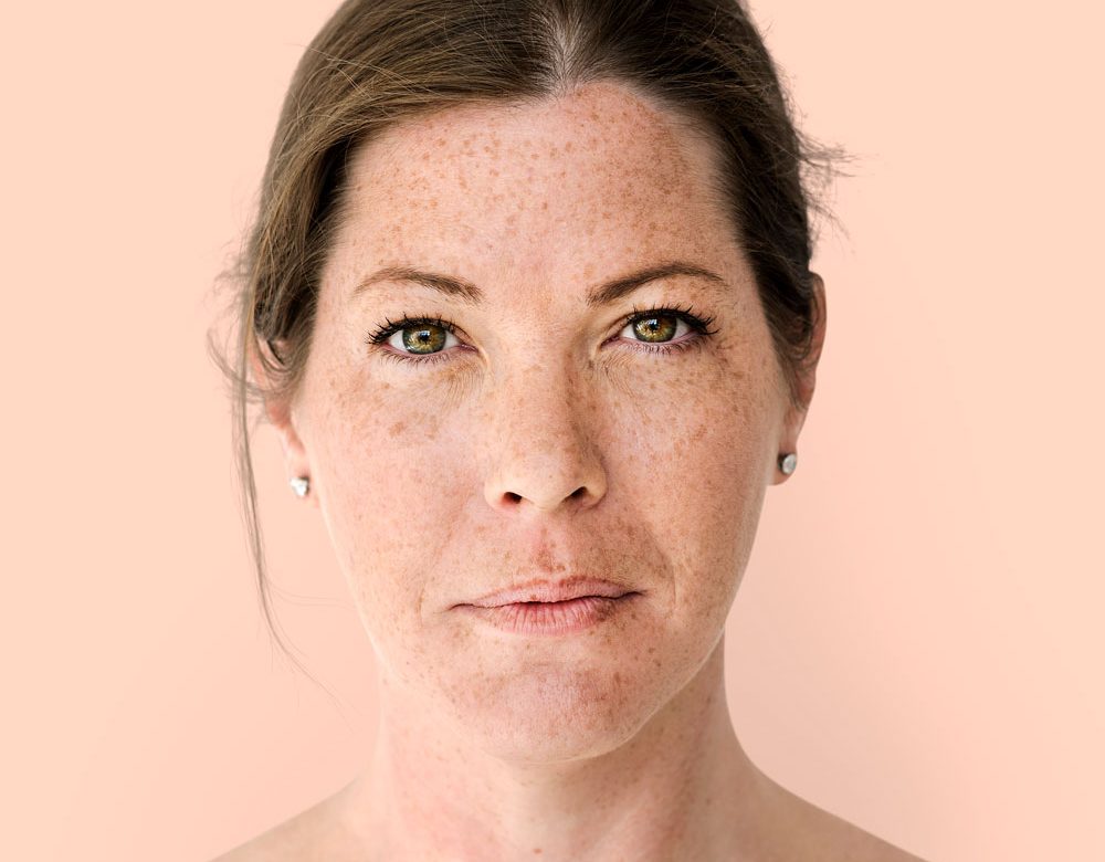 El desafío del melasma por qué las manchas en la piel requieren un abordaje médico