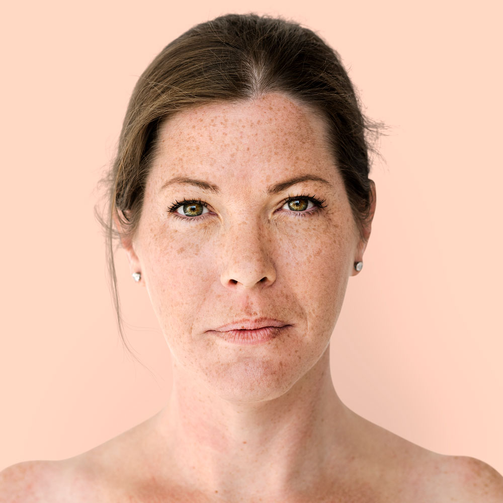 El desafío del melasma por qué las manchas en la piel requieren un abordaje médico