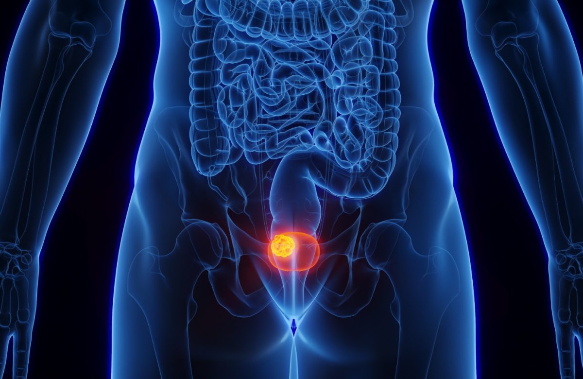 Costa Rica incorpora una nueva inmunoterapia para el cáncer de vejiga músculo invasivo