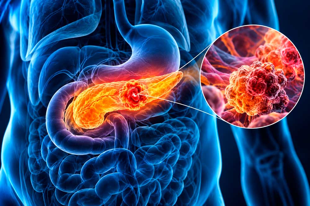 Cáncer de páncreas, una innovadora terapia abre nuevas posibilidades de tratamiento